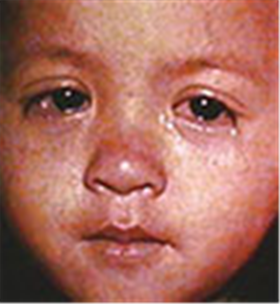 child-measles.jpg